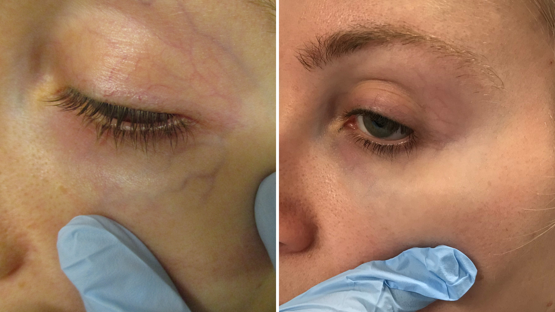 Laser Removal Before And After