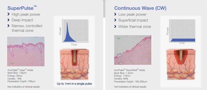 Acupulse Laser Graphic
