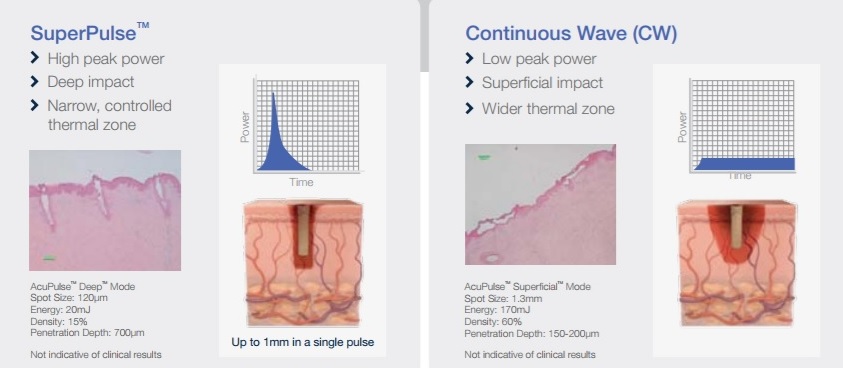 acupulse laser graphic