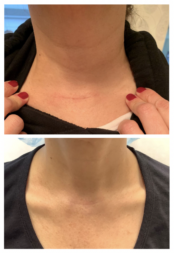 Scar intervention before after 2 Madfes Dermatology & Aesthetics