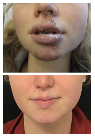 Scar intervention before after 3 Madfes Dermatology & Aesthetics