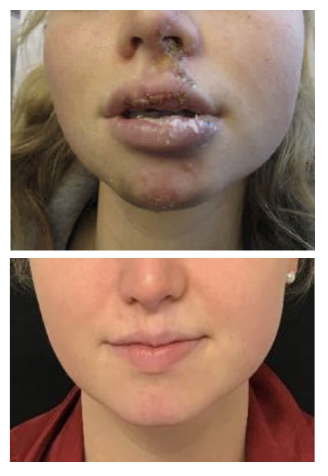 Scar Intervention Before After 3 Madfes Dermatology &Amp; Aesthetics