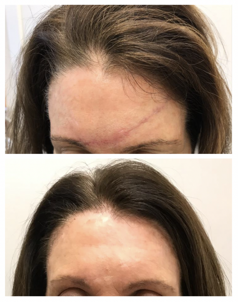 Scar intervention before after Madfes Dermatology & Aesthetics