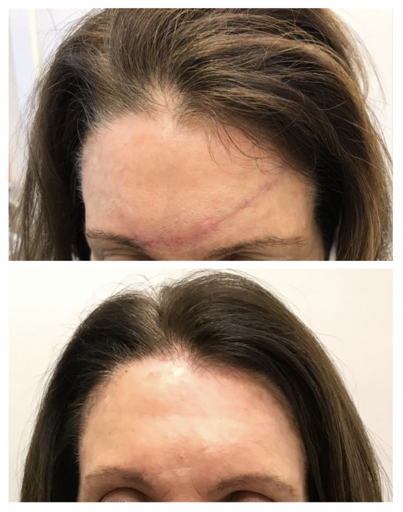 Scar Intervention Before After Madfes Dermatology &Amp; Aesthetics