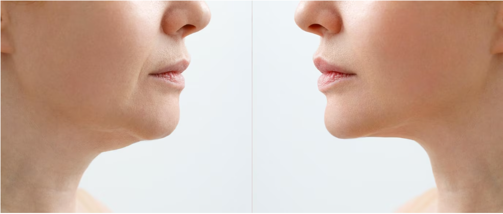 before and after picture of tightened chin due to thermage