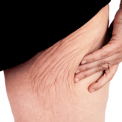 Woman With Wrinkly Upper Thighs