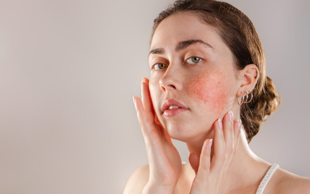Understanding Rosacea: Causes, Triggers, and Treatment Approaches
