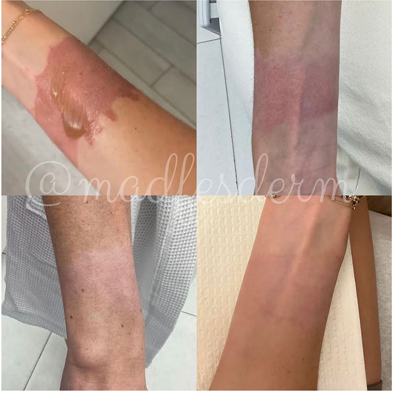 Scar Intervention Before And After Burn Photo