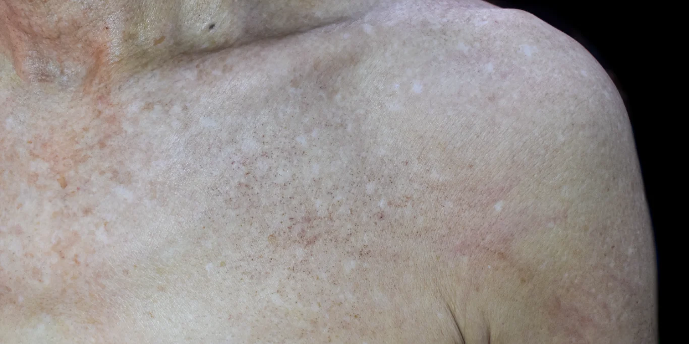 sun damaged chest sun damaged chest